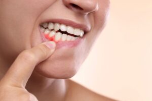 Taking Care of Your Gums