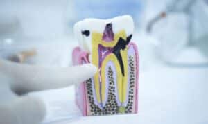 Tooth decay