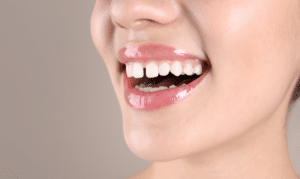 Widely Spaced Teeth