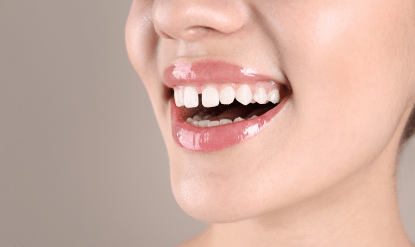 Widely Spaced Teeth
