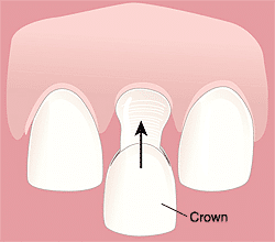 Dental crown placement illustration showing a tooth receiving a restoration between two natural teeth.