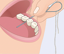 Illustration showing proper flossing technique around dental crowns and bridges on upper teeth.