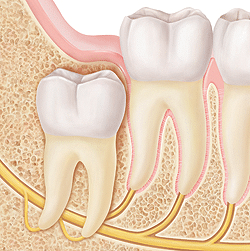 Anatomical diagram showing wisdom teeth development and impaction stages in the jawbone.