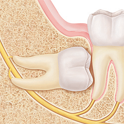 Impacted wisdom tooth illustration showing tooth trapped in jawbone, relevant to Tullahoma dental care.