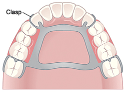 Partial denture diagram showing clasps on upper teeth for secure fit and retention.