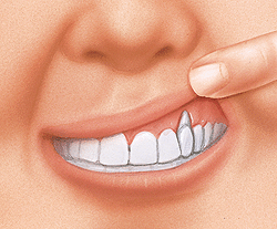 Close-up of a patient's smile showing white teeth and gum line for periodontal disease assessment.