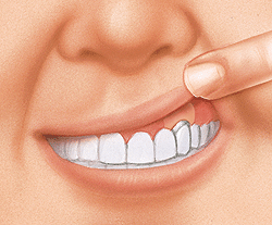 Close-up of a patient's bright white smile showing healthy teeth and gums after periodontal treatment.