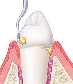 Diagram of gum tissue cross-section showing nonsurgical periodontal treatment technique with instrument placement.