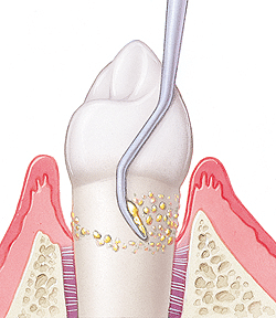 Illustration of nonsurgical periodontal treatment showing gum disease progression and plaque removal.