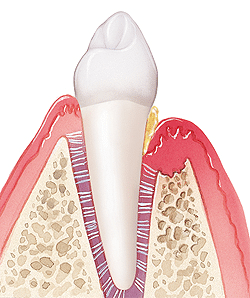 Diagram of periodontal pocket reduction surgery showing tooth cross-section and gum tissue removal.