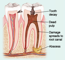 Cross-section diagram showing tooth decay progression, dead pulp, and root canal abscess requiring endodontic treatment.