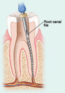 Cross-section diagram of a tooth showing root canal file placement during endodontic therapy.