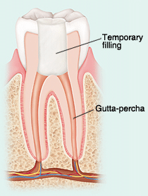 Diagram showing tooth cross-section with temporary filling and gutta-percha during root canal therapy.