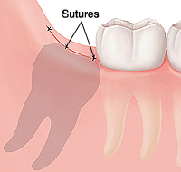 The wisdom tooth is removed through an incision. The incision is closed with sutures.
