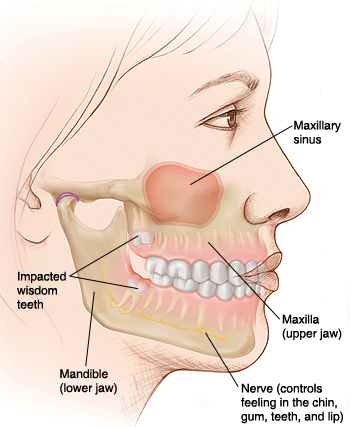 Anatomical diagram of wisdom teeth and surrounding facial structures including maxillary sinus and mandible.