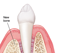 Guided tissue regeneration diagram showing new bone formation in periodontal disease treatment.