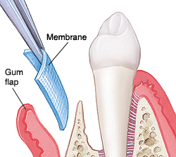 Surgery on gum and bone