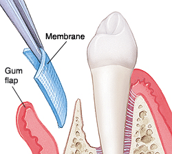 Guided tissue regeneration membrane placement diagram showing gum flap, membrane, and tooth structure for periodontal treatm.