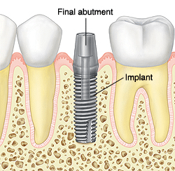 Dental implant diagram showing abutment placement and prosthesis components in jawbone structure.