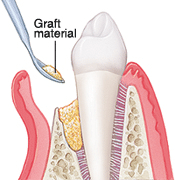 Bone replacement graft procedure showing graft material placement in periodontal defect area.