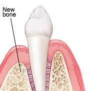 Dental bone graft illustration showing new bone formation in a tooth socket after periodontal disease treatment.