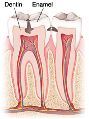 Once tooth decay eats through the enamel, it spreads quickly through the softer dentin.