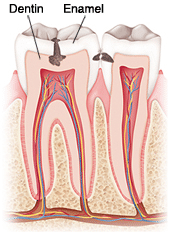 Diagram showing tooth decay progression through dentin and enamel layers with color-coded cross-section.