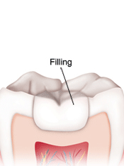 Diagram showing tooth decay progression with filling treatment restoring a decayed tooth structure.