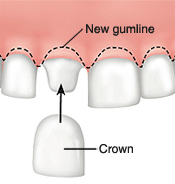 Dental crown lengthening diagram showing new gumline and crown placement for periodontal treatment.