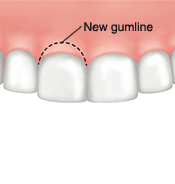 Illustration of new gumline after crown lengthening procedure for periodontal disease treatment in Tullahoma.