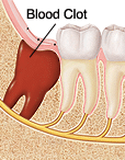 Diagram showing blood clot formation in tooth socket after wisdom tooth extraction.