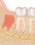 Diagram showing wisdom tooth anatomy with cross-section view of tooth structure and surrounding bone.