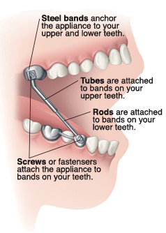 Diagram of Herbst appliance components anchored to upper and lower teeth with bands, tubes, rods, and screws.