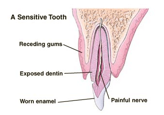 Cross-section of a sensitive tooth showing receding gums, exposed dentin, worn enamel, and irritated nerve.