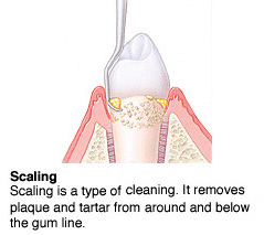 Dental scaling procedure illustration showing plaque removal from tooth and gum line.