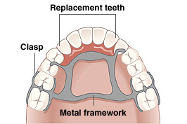 Partial denture diagram showing replacement teeth, clasps, and metal framework for Tullahoma dental care.