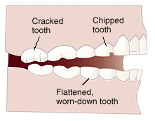 Illustration showing three types of tooth damage from bruxism: cracked tooth, chipped tooth, and flattened worn-down tooth.