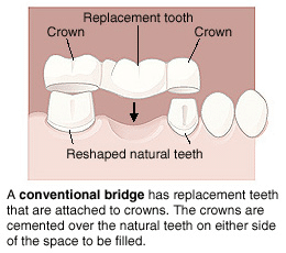 Diagram showing how a dental bridge replaces missing teeth with crowns cemented over natural teeth on either side.