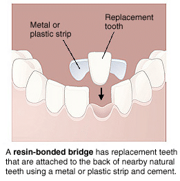 Resin-bonded bridge diagram showing replacement tooth attached to adjacent natural teeth using metal or plastic strip and ce.