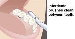 Interdental brush cleaning between teeth as part of bridge care routine.