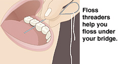 Floss threaders help you floss under your dental bridge.