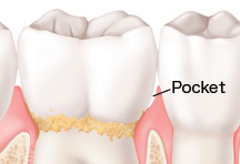 Diagram showing a periodontal pocket between tooth and gum tissue during gum disease.