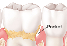 Diagram showing gum pocket formation in periodontal disease with anatomical labels.
