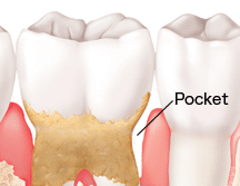 Dental pocket formation showing gum recession and bone loss in periodontal disease.