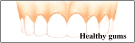 Healthy gums with pink tissue and white teeth shown in dental illustration.