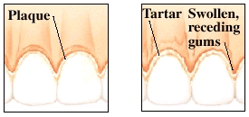 Illustration comparing healthy gums with plaque to receding gums with tartar buildup.