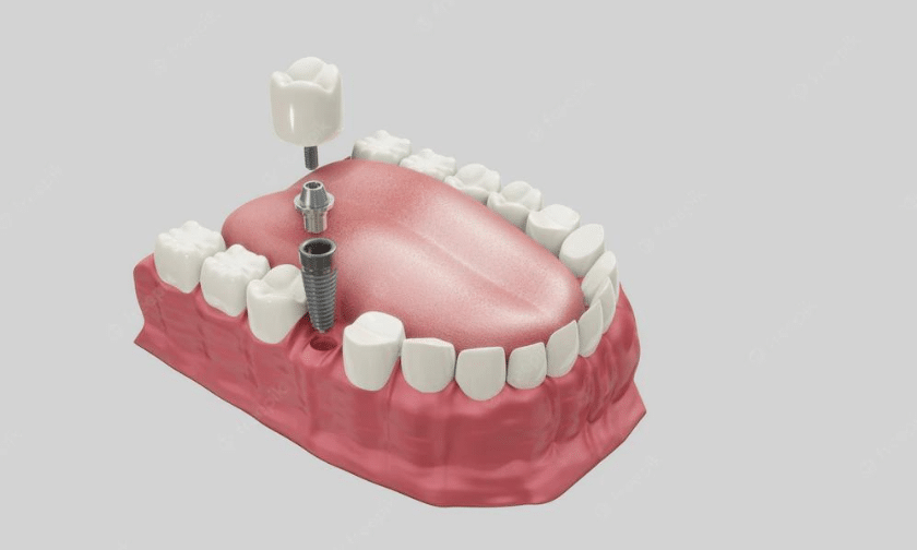 Dental Implants