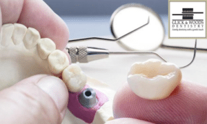 How To Take Care Of A Dental Crown - A Quick Guide