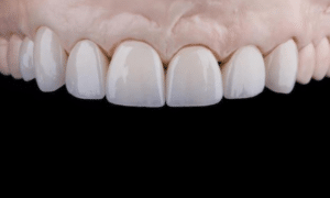 The Importance of Restorative Dentistry in Modern Dental Care
