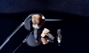 What Are The Best Dental Implants & Which One Fits Your Needs